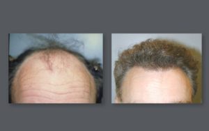 NeoGraft from Vein Med Solutions Aesthetic Med Spa