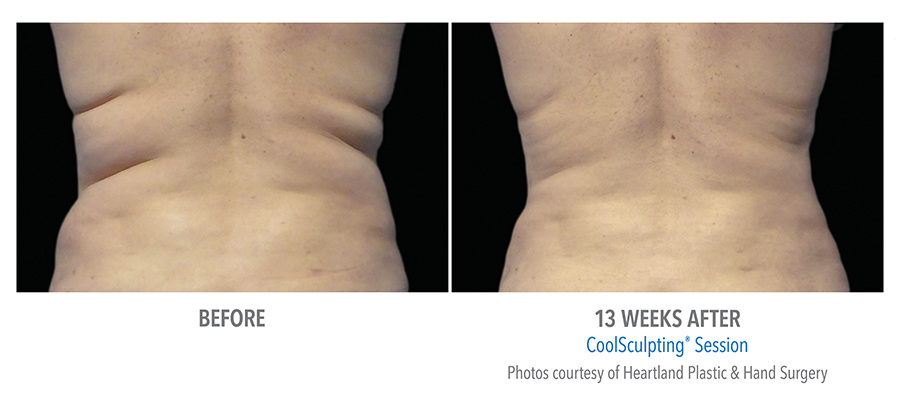 https://www.veinmedsolutions.com/wp-content/uploads/2017/11/coolsculpting-2-vein-med-solutions-1-900x403.jpg