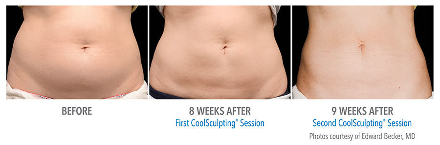 https://www.veinmedsolutions.com/wp-content/uploads/2017/11/coolsculpting-3-vein-med-solutions-1-900x297.jpg