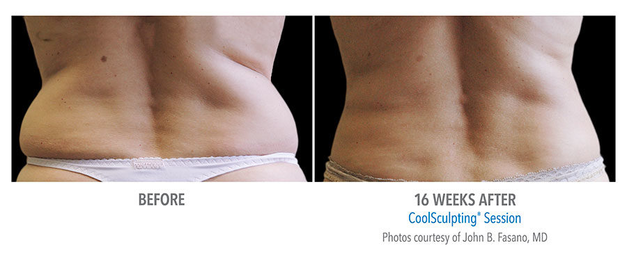 https://www.veinmedsolutions.com/wp-content/uploads/2017/11/coolsculpting-vein-med-solutions-1-900x403.jpg