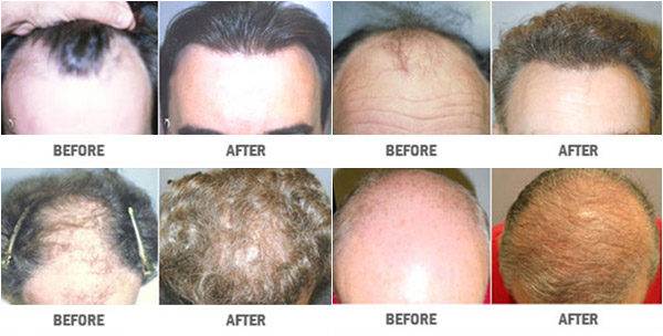 https://www.veinmedsolutions.com/wp-content/uploads/2017/11/hair-restoration-vein-med-solutions-1-600x304.jpg