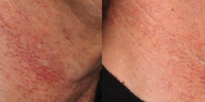 https://www.veinmedsolutions.com/wp-content/uploads/2017/11/vein_med_solutions_Brown_Spots_and_Dark_Pigmentations-400x200.png