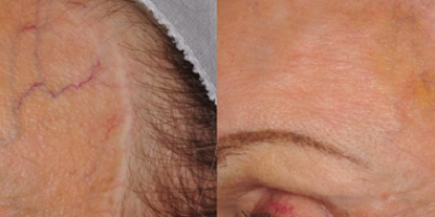 https://www.veinmedsolutions.com/wp-content/uploads/2017/11/vein_med_solutions_facial_veins_removal-400x200.png