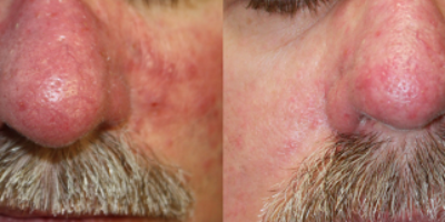 https://www.veinmedsolutions.com/wp-content/uploads/2017/11/vein_med_solutions_treats_rosacea-400x200.png