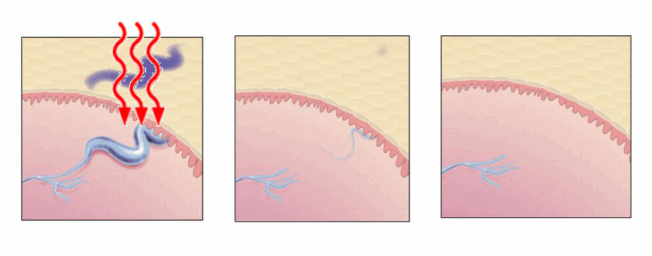 https://www.veinmedsolutions.com/wp-content/uploads/2025/06/Varicose_Veins_Screenshot-2025-06-10-144958-652x256.png