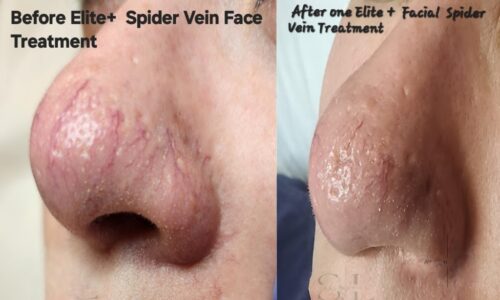 https://www.veinmedsolutions.com/wp-content/uploads/2025/06/picmonkey_image-1-2-500x300.jpg