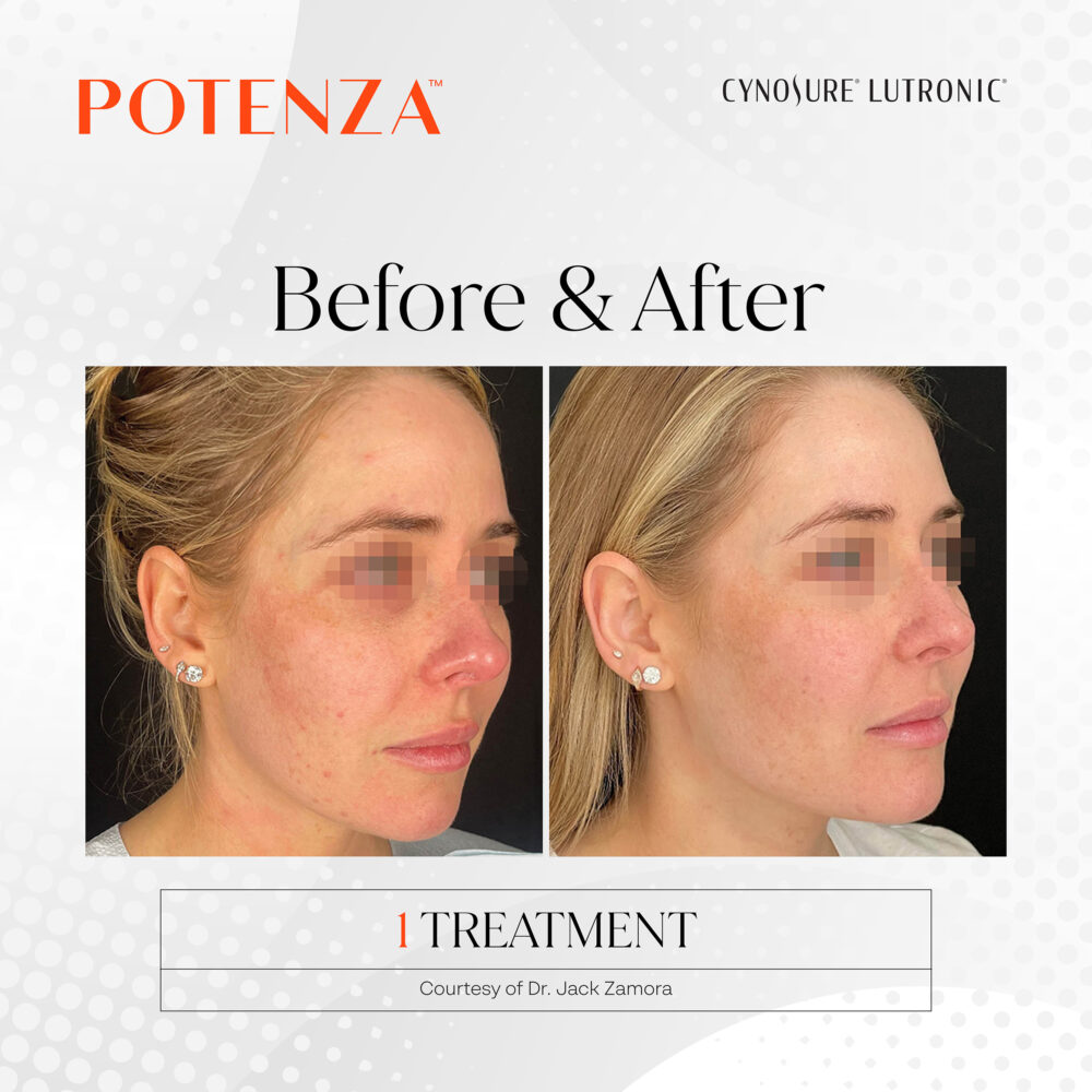 Potenza Rfm Facial Skin Revitalization | Vein Med Solutions | Aesthetic Med Spa